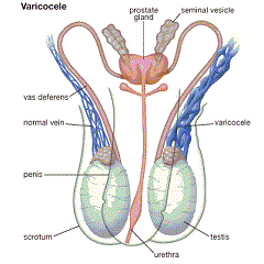 Обратный кровоток в яичковой вене причина варикоцеле